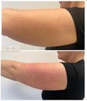 Arm Before and After